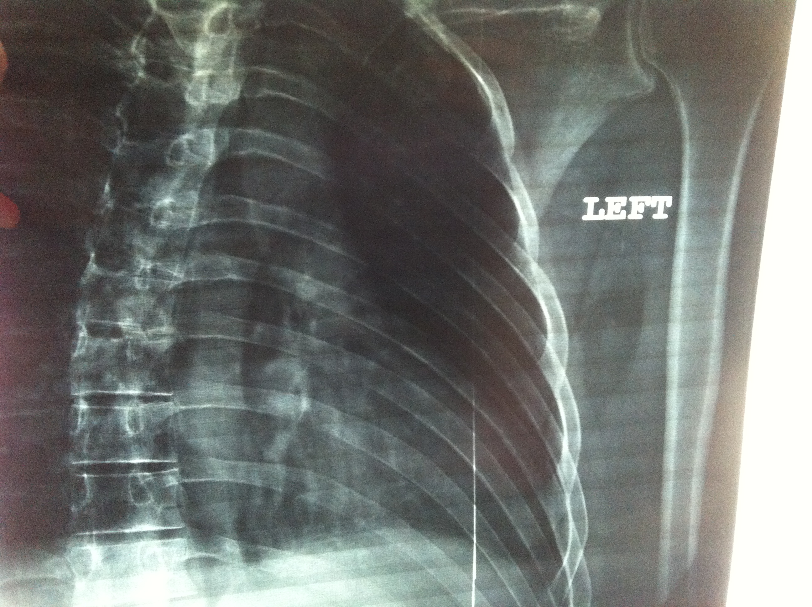 bruised ribs x ray